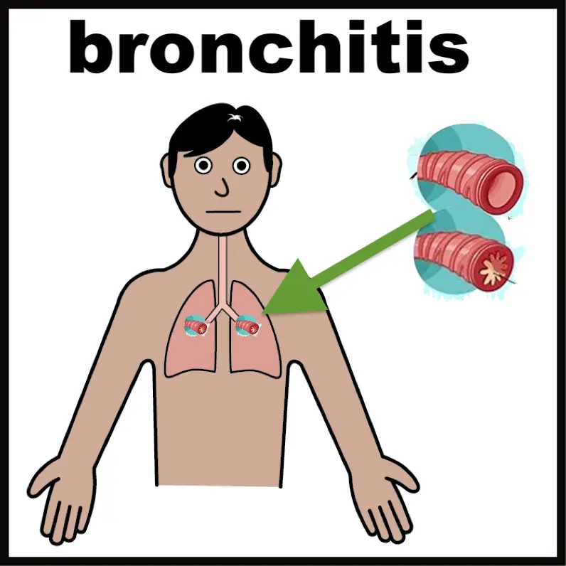 Bronchitis