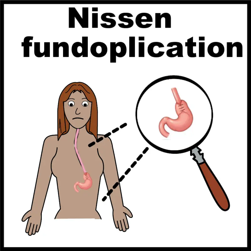 Nissen's fundoplication