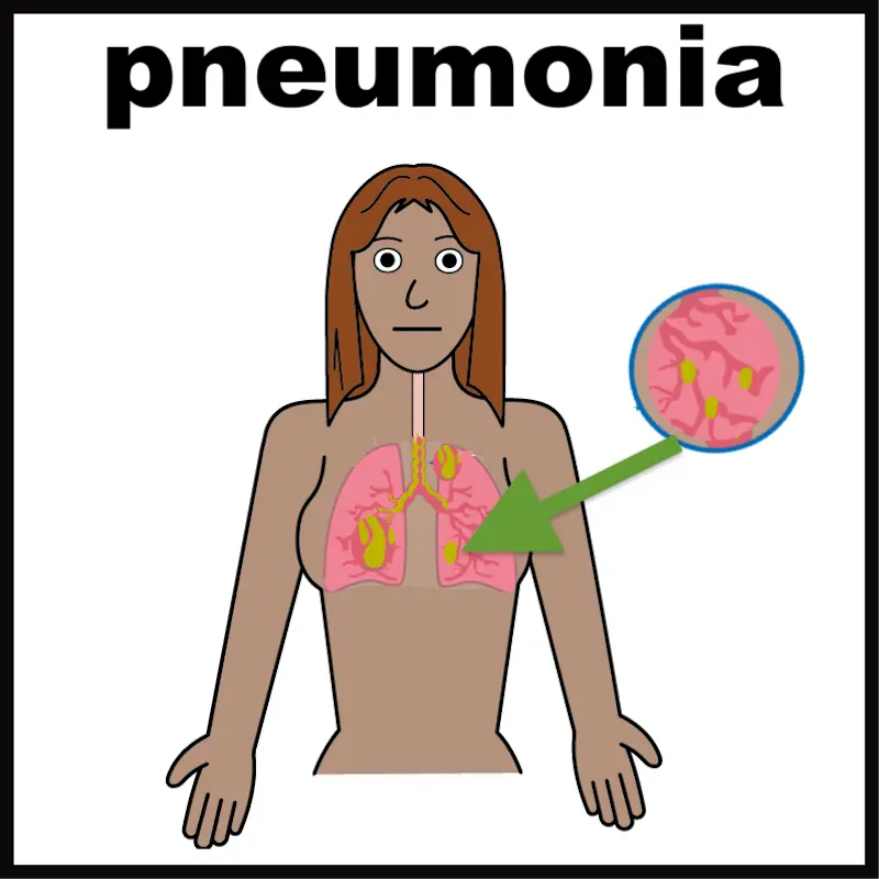 Pneumonia