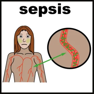 Sepsis